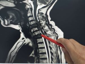 Doctor inspects MRI Scan for paralysis injuries