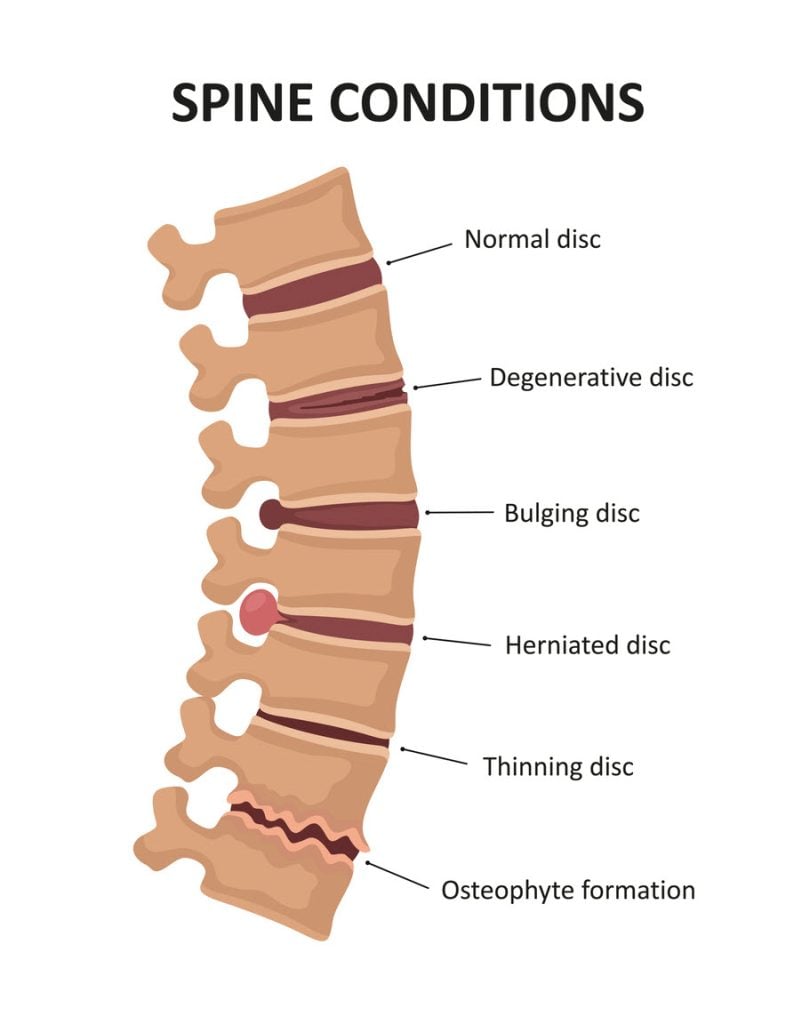 Infografía del estado de la columna vertebral con disco normal, disco degenerativo, disco abultado, disco herniado, disco adelgazado y formación de osteofitos